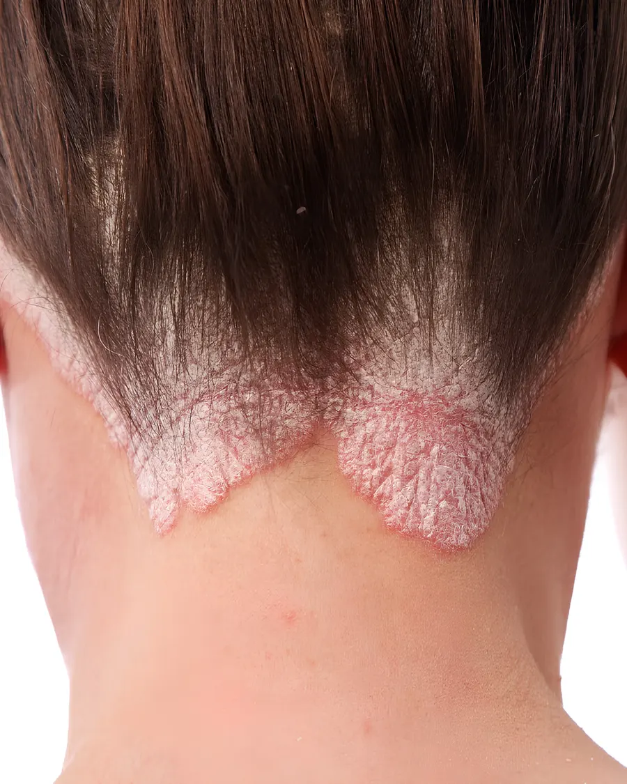 Advanced Scalp Care at Cinch Clinics